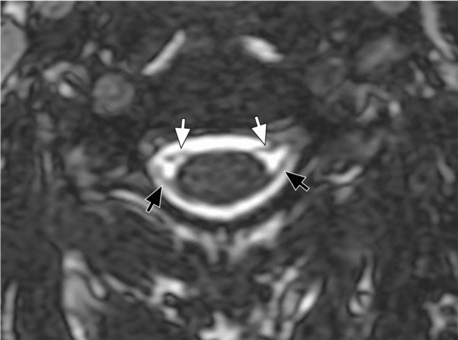 Axial high-resolution MRI of the cervical cord with arrows marking the small ventral and dorsal nerve rootlets