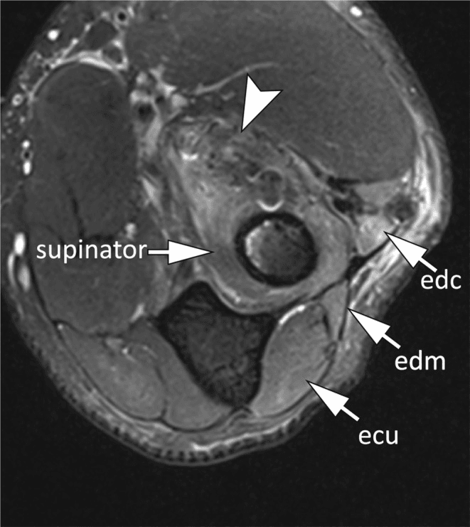 Axial forearm MRI showing posterior interosseous nerve entrapment by postoperative scar with denervation of supinator and the extensors