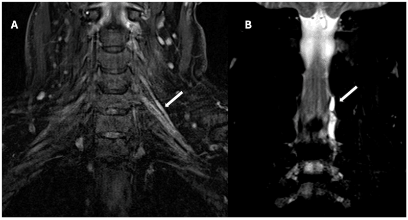 Coronal MR neurography panels A and B showing postganglionic brachial plexus injury and a pseudomeningocele