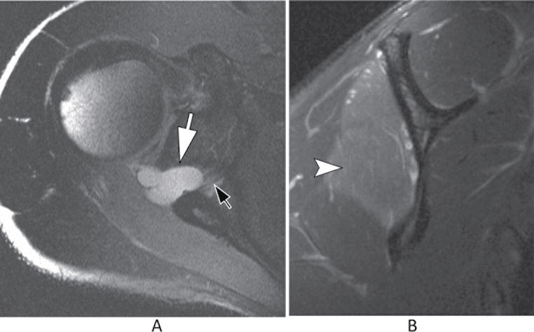 MRI panels A and B showing a paralabral cyst at the spinoglenoid notch and denervation oedema in infraspinatus