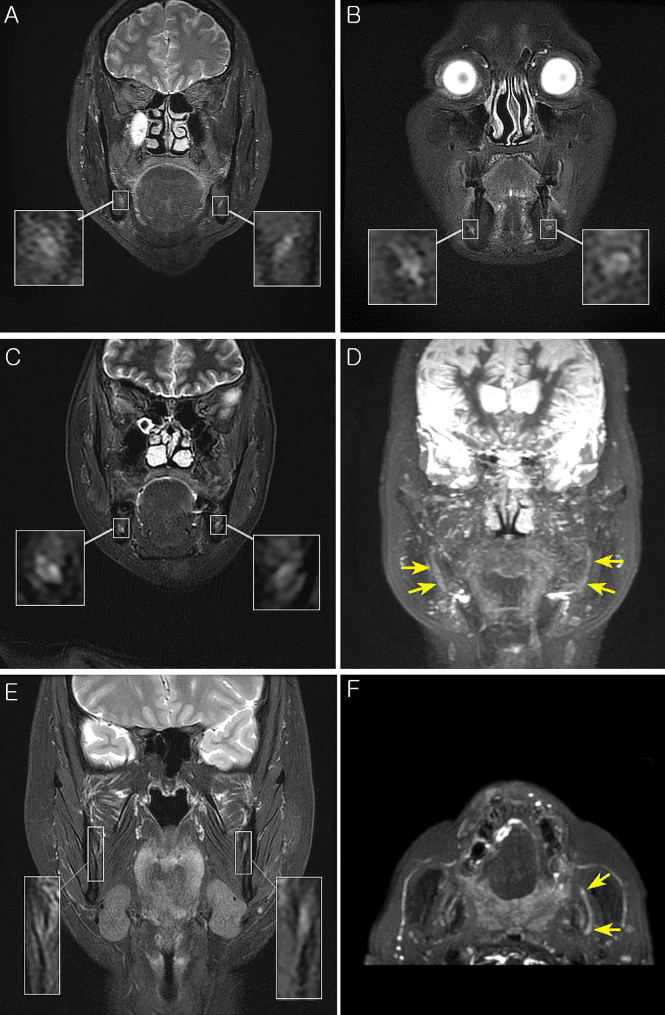 High-resolution MR neurography panels A to F of the inferior alveolar nerves after trauma, with magnified insets of each side and arrows