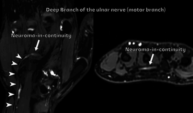 MR neurography of the deep motor branch of the ulnar nerve with a labelled neuroma-in-continuity in longitudinal and cross-sectional views