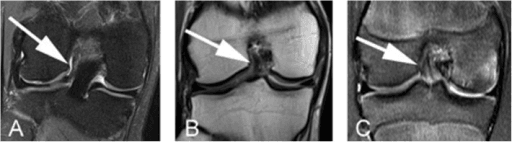 Comparison of MRI sequences showing pathology detection in musculoskeletal imaging