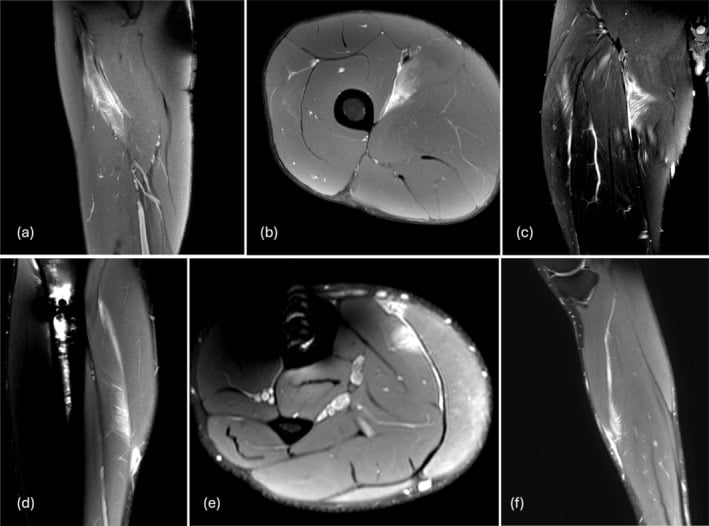 Multiplanar fluid-sensitive MRI of an adductor longus muscle injury classified by BAMIC