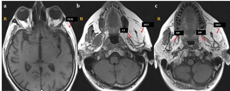 Axial T1 MRI showing chronic denervation-related fatty atrophy of muscles of mastication
