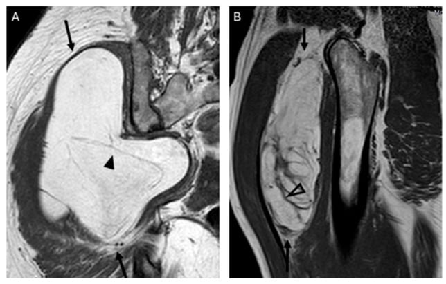 T1-weighted MRI comparing a homogeneous lipoma with an atypical lipomatous tumour containing thick septa