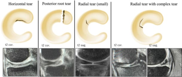 MRI examples and schematics of horizontal, posterior-root, radial and complex meniscal tears