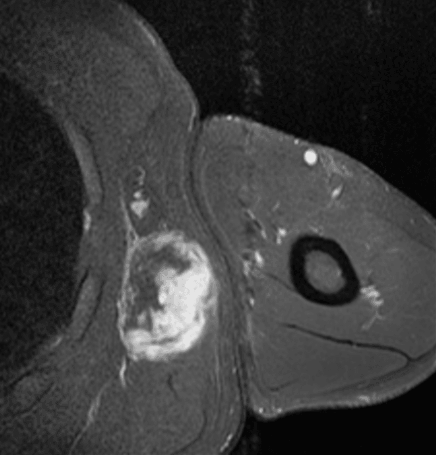 Axial fluid-sensitive MRI of a high-grade myxoid liposarcoma in the axilla