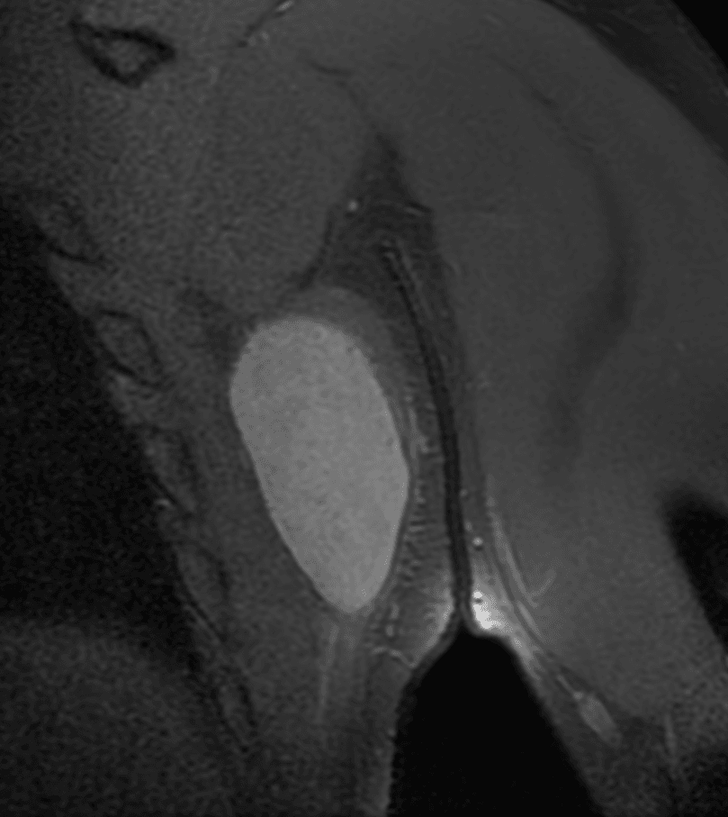 Coronal fluid-sensitive MRI of the same axillary myxoid liposarcoma