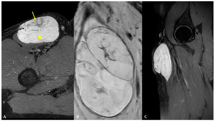 Multiplanar conventional MRI of a femoral myxoid liposarcoma