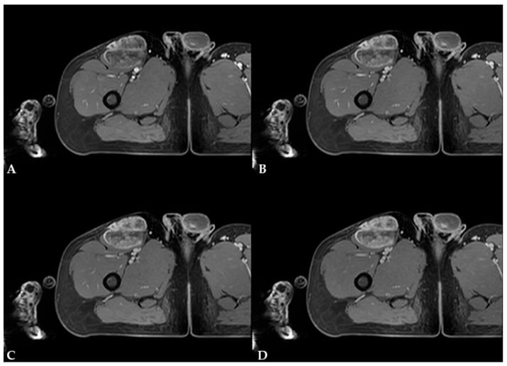 Serial post-contrast T1 MRI showing dynamic enhancement of myxoid liposarcoma