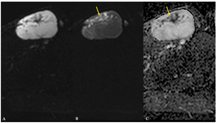 Diffusion-weighted MRI and ADC map of myxoid liposarcoma