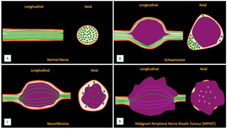 Diagram comparing normal nerve, schwannoma, neurofibroma and malignant peripheral nerve sheath tumour growth patterns