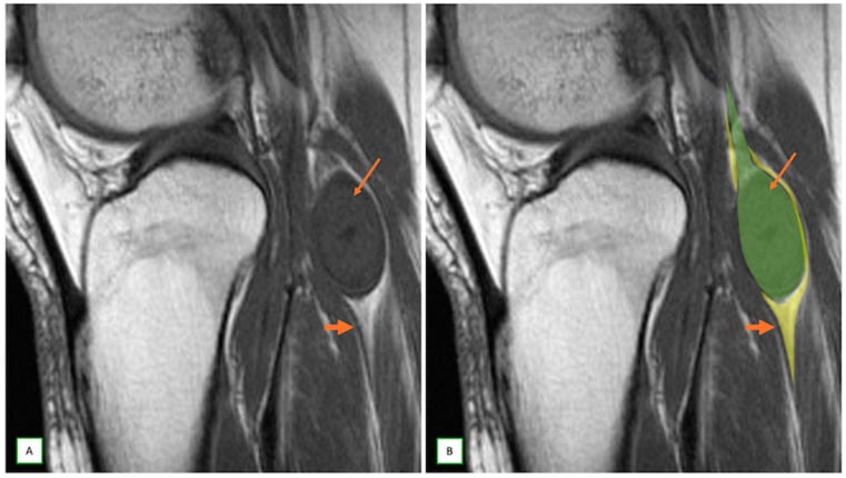 Sagittal T1 MRI of a tibial nerve schwannoma showing split-fat and tail signs
