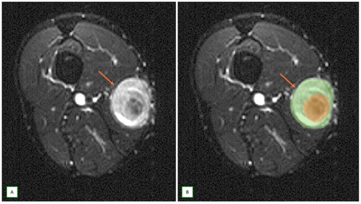 Axial fat-saturated T2 MRI of a neurofibroma showing the target sign
