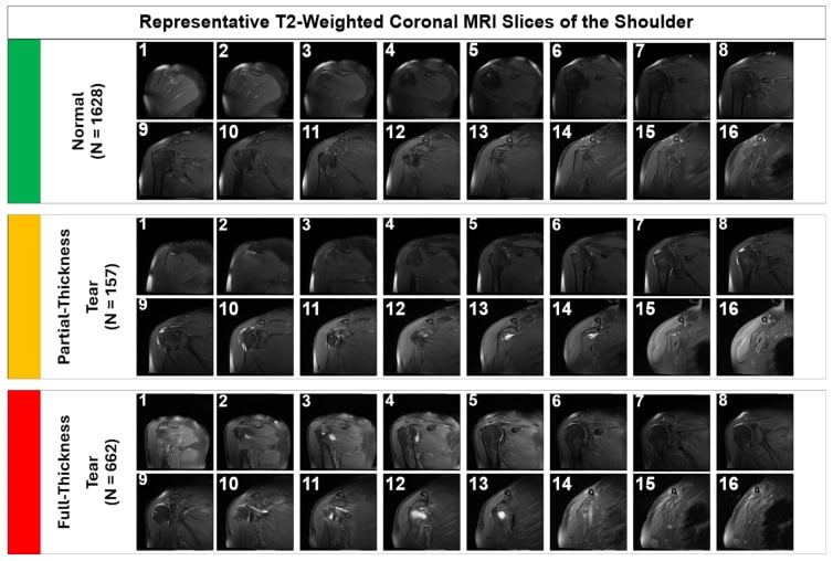 Coronal T2-weighted shoulder MRI examples spanning normal supraspinatus tendon, partial-thickness tear and full-thickness tear