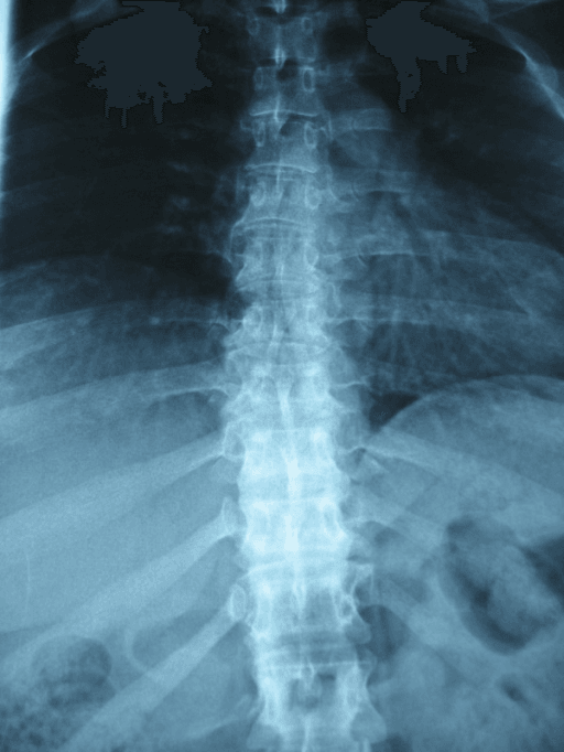 Thoracic radiograph in mucopolysaccharidosis showing broad, paddle-shaped ribs that narrow at their vertebral ends.