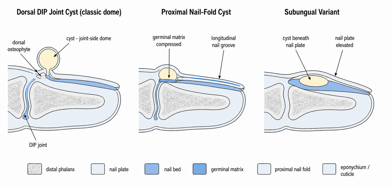 Three-panel schematic comparing the dorsal DIP joint cyst, the proximal nail-fold cyst, and the subungual variant of digital mucous cyst, showing their relationship to the germinal matrix and nail plate.