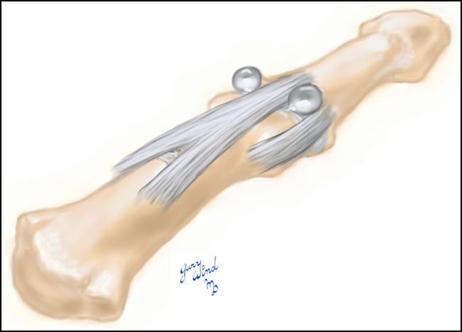 Illustration of a dumbbell digital mucous cyst extending on both sides of the terminal extensor tendon
