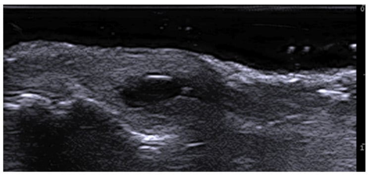Ultrasound image showing a sharply circumscribed, anechoic oval digital myxoid cyst in the soft tissue