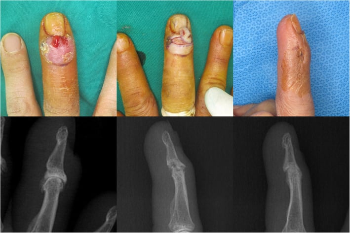 Clinical and radiographic sequence of a distal interphalangeal joint drainage sinus treated with debridement
