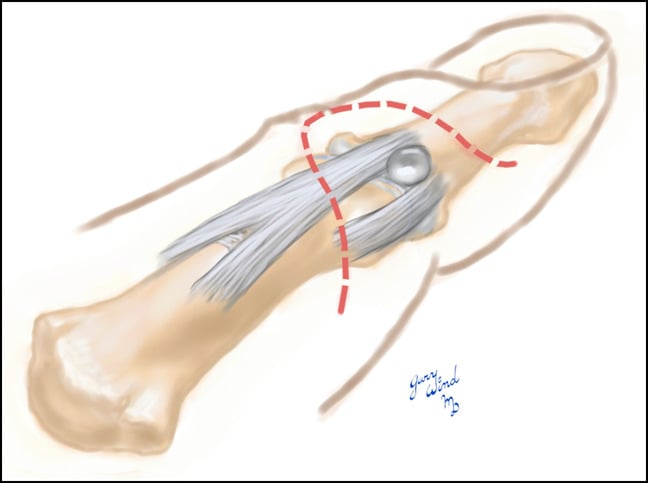 Illustration of a planned dorsal finger flap incision (dashed red line) over the DIP joint and the mucous cyst