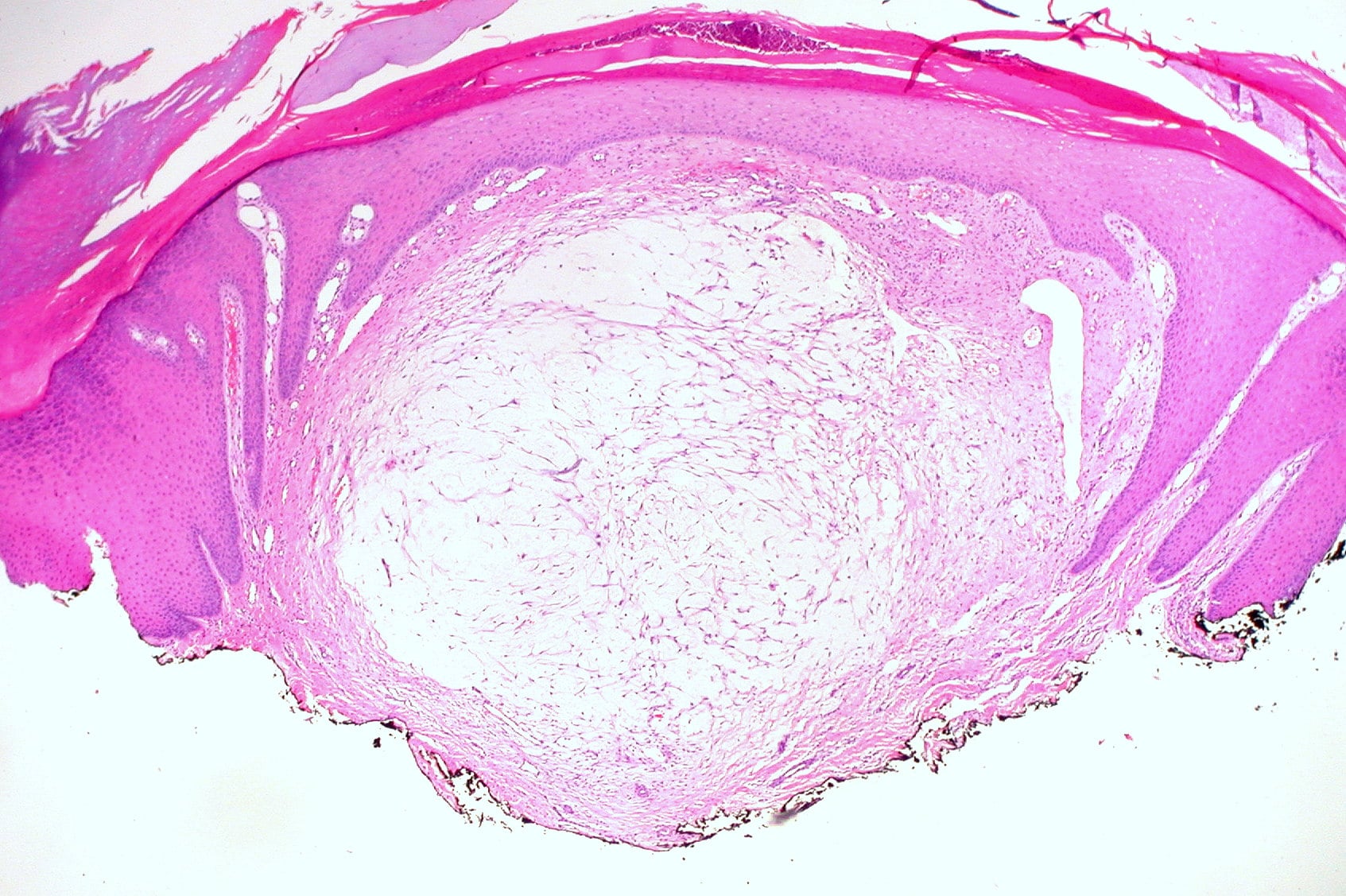 Low-power histology of a digital mucous cyst showing a well-circumscribed myxoid pseudocyst beneath intact epidermis, with no epithelial lining.