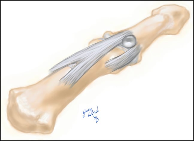 Illustration of a digital mucous cyst stalk passing between the extensor mechanism and collateral ligament