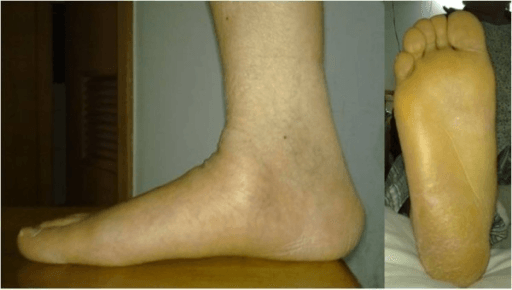 Clinical photograph of a foot with a flattened medial longitudinal arch and neutral hindfoot alignment.
