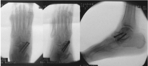 Post-operative radiograph centred on the talonavicular joint.