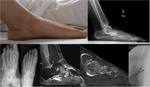 Imaging of both feet showing Müller-Weiss syndrome with flattened medial arches, sunken talar heads and talonavicular fusion.