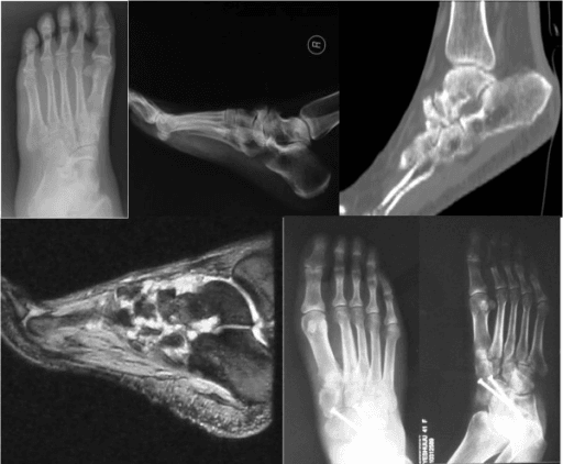 Radiograph of right foot with Müller-Weiss syndrome after talonavicular arthrodesis with two screws.