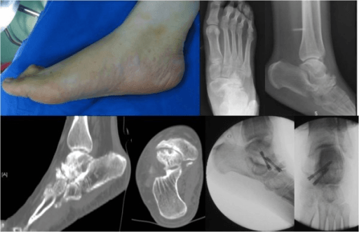 Radiograph of a right flatfoot with Müller-Weiss syndrome showing talonavicular arthrodesis fixed with two screws.