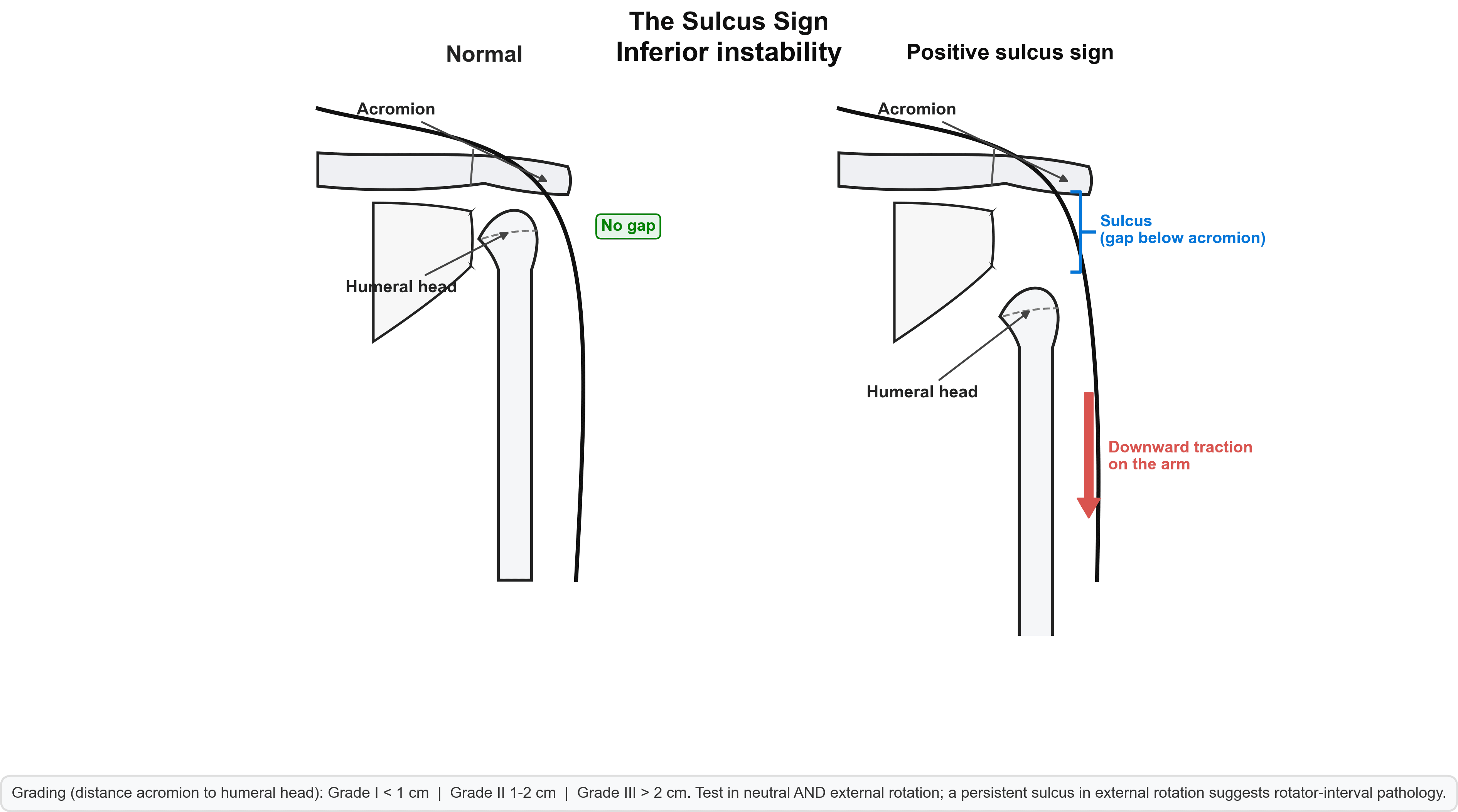 Schematic of the sulcus sign comparing a normal shoulder with a positive sulcus sign, where downward traction on the arm drops the humeral head and opens a gap below the acromion