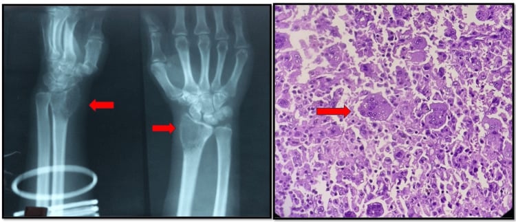 Radiograph of a distal radius with a subarticular soap-bubble lucency, paired with giant-cell histology.