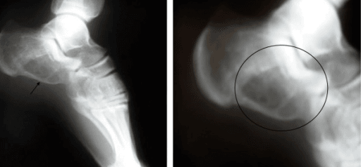 Radiograph of the heel showing an expansile well-defined lucent lesion in the front of the calcaneus.