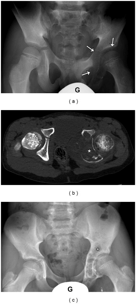 Plain radiograph of the pelvis with arrows marking a large expansile lucent lesion in the medial left acetabulum.