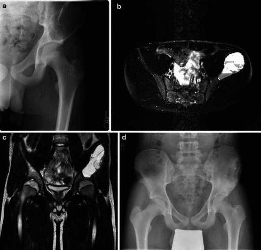 Anteroposterior pelvic radiograph showing an expansile lucent lesion in the left iliac wing near the acetabulum.