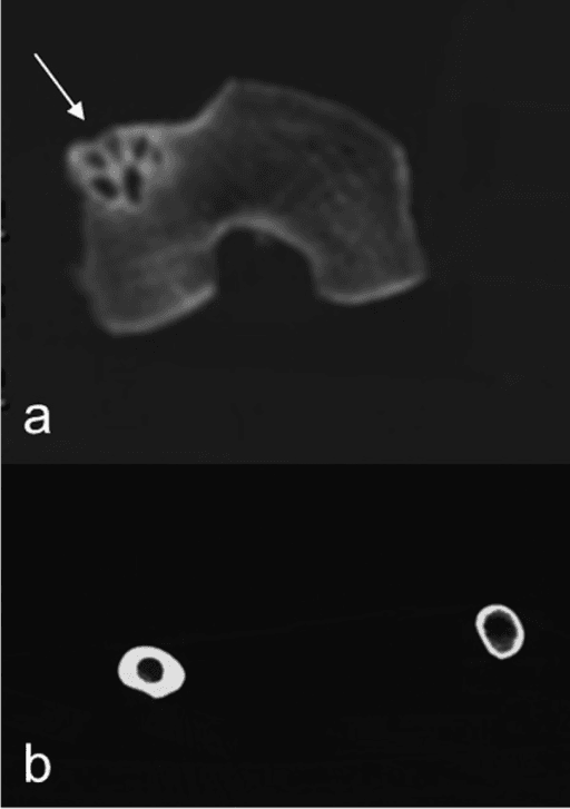 Imaging of both knees showing a multiloculated cystic lesion in the lateral condyle of the right femur and thickened bone on the opposite side.