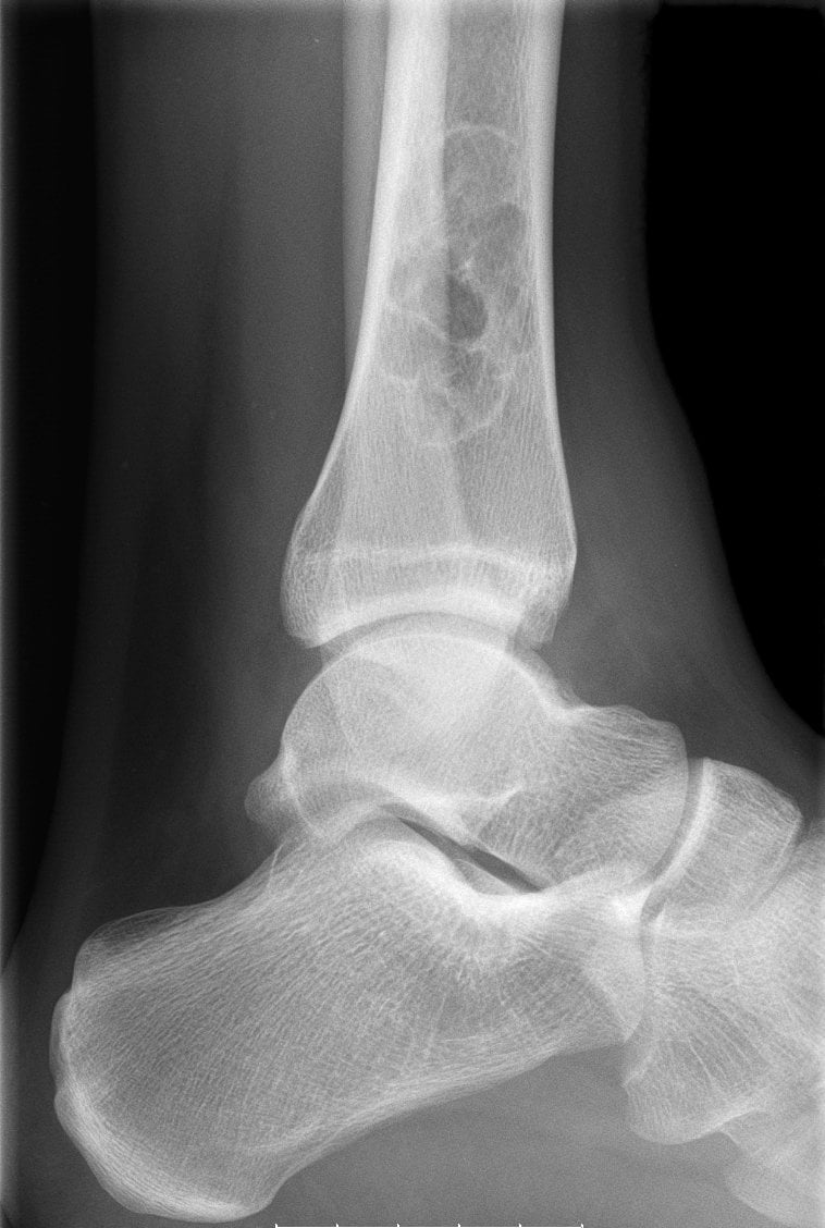 Lateral radiograph of a tibia with a cortically based, scalloped, sclerotic-rim lucency of a non-ossifying fibroma.