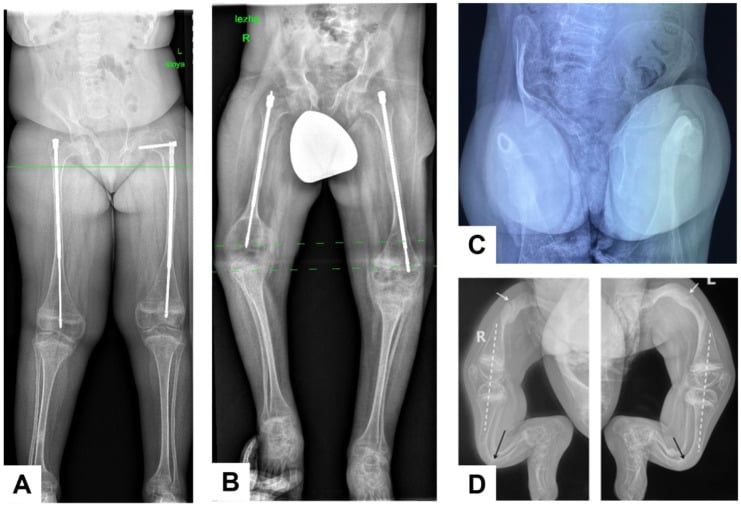 Pelvis and lower-limb radiographs showing fractures deformity and rods in Bruck syndrome