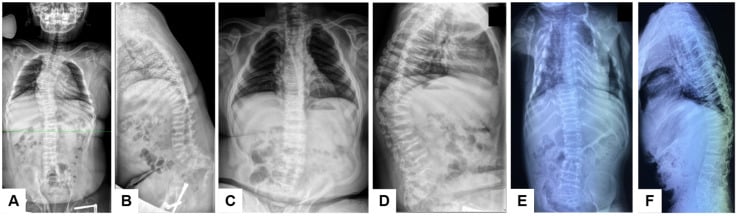 Spine radiographs showing scoliosis kyphosis platyspondyly and vertebral wedging in Bruck syndrome