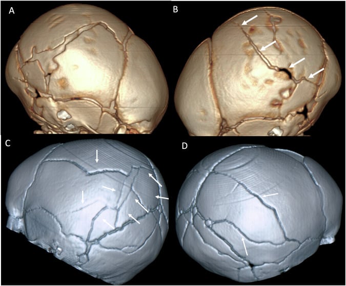 Three-dimensional CT showing complex bilateral parietal skull fractures in infants
