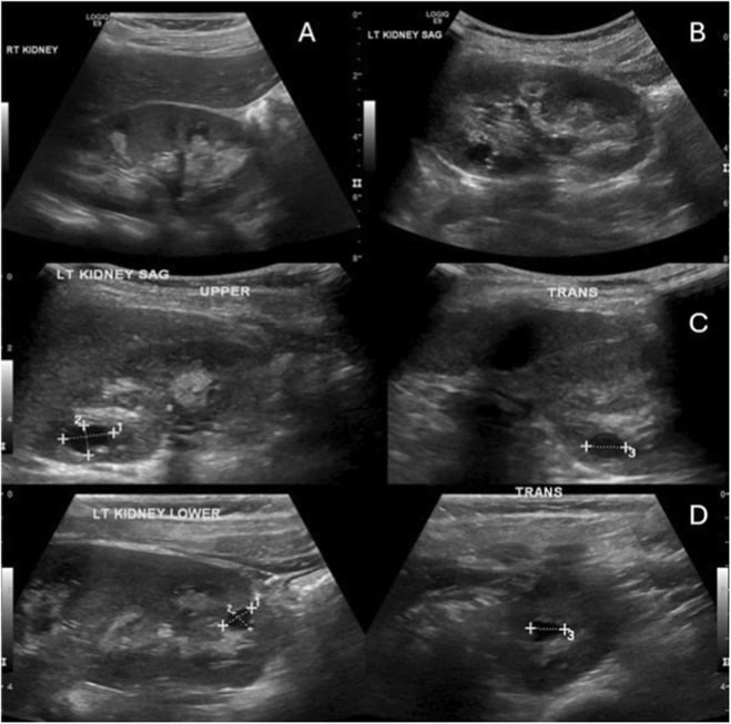 Renal ultrasound showing nephrocalcinosis in infantile hypophosphatasia