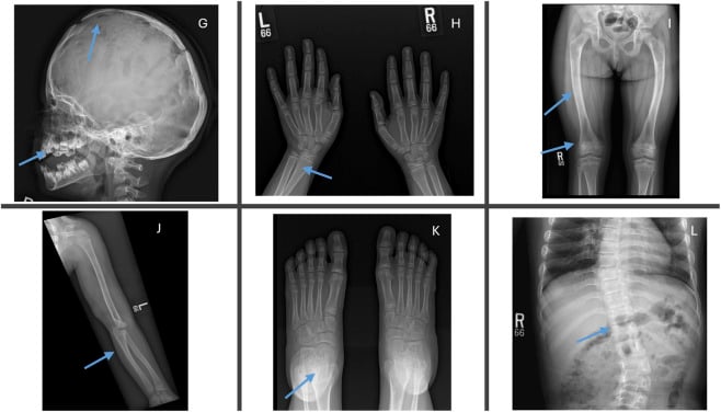 Follow-up skull hand spine and limb radiographs after asfotase alfa in hypophosphatasia