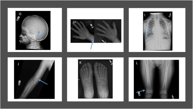 Follow-up skeletal survey showing improved mineralisation after hypophosphatasia treatment