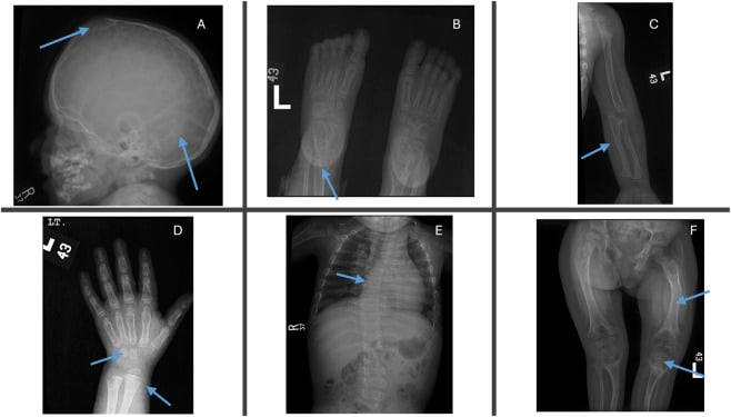 Skull foot hand chest and lower-limb skeletal survey in infantile hypophosphatasia
