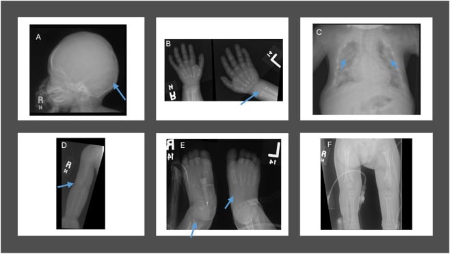 Skeletal survey showing generalized osteopenia and metaphyseal abnormalities in hypophosphatasia
