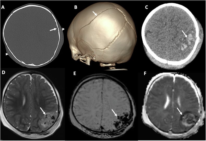 CT three-dimensional reconstruction and MRI showing infant impact skull injury