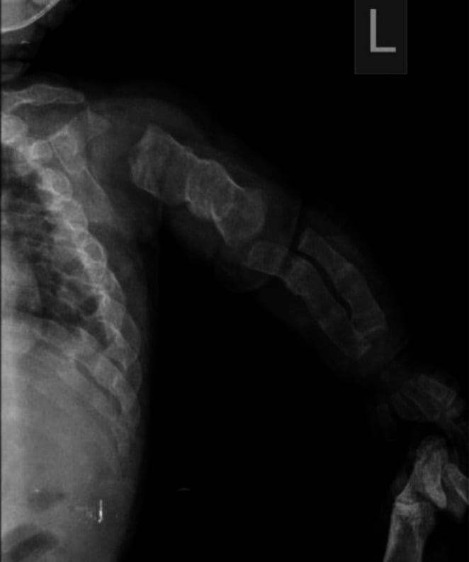 AP chest radiograph demonstrating multiple rib fractures of varying ages